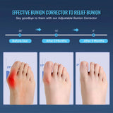 Bunion Corrector